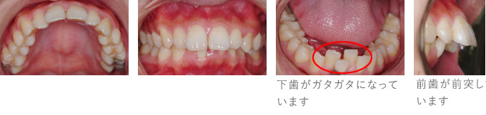 治療前 外科矯正（保険）　Y様　骨格が原因の出っ歯（上顎前突）
