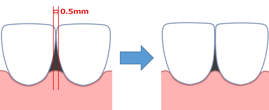 矯正治療で歯を削る ストリッピングのメリットとデメリット 長崎の矯正専門 すずき矯正歯科