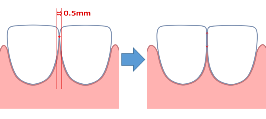 矯正治療で歯を削る ストリッピングのメリットとデメリット 長崎の矯正専門 すずき矯正歯科