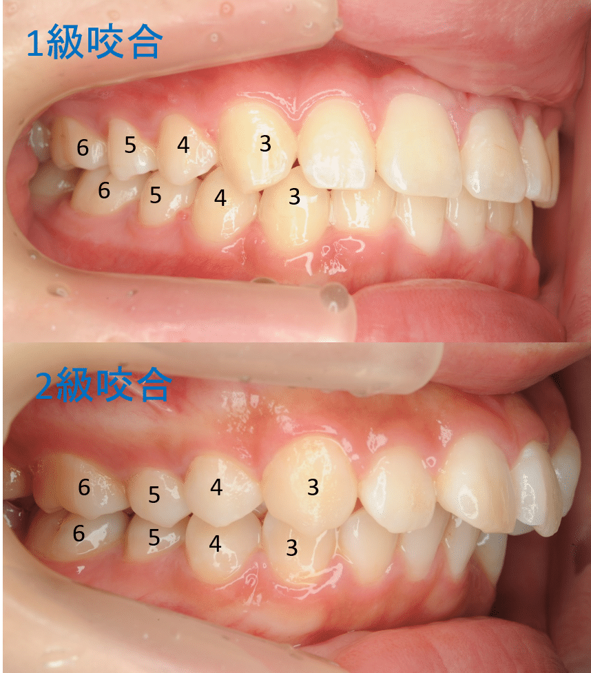 口元突出の原因は出っ歯 矯正歯科治療で治る 長崎の矯正専門 すずき矯正歯科