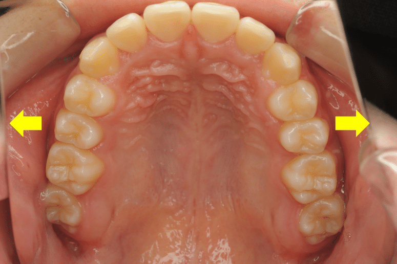 矯正治療における抜歯、非抜歯の４つ基準とは？ | 長崎の矯正専門「すずき矯正歯科」