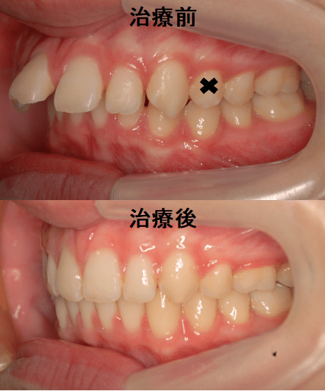 矯正治療における抜歯 非抜歯の４つ基準とは 長崎の矯正専門 すずき矯正歯科