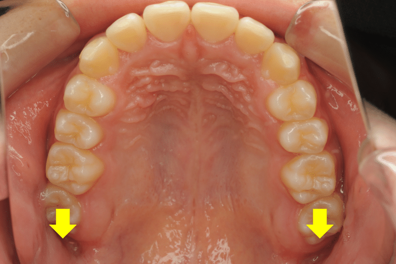 歯列の後方拡大