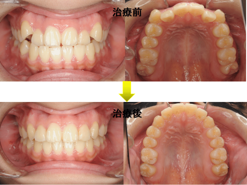 歯列前方拡大症例