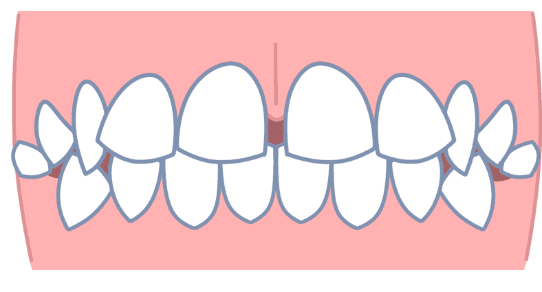 すきっ歯は原因別に治療しないと治らない あなたにあった治療法はどれ 長崎の矯正専門 すずき矯正歯科