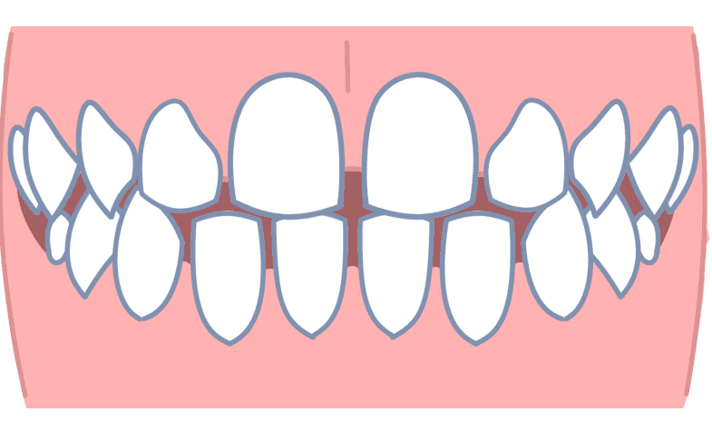 すきっ歯は原因別に治療しないと治らない あなたにあった治療法はどれ 長崎の矯正専門 すずき矯正歯科