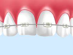 セラミックブラケット（目立たない矯正）