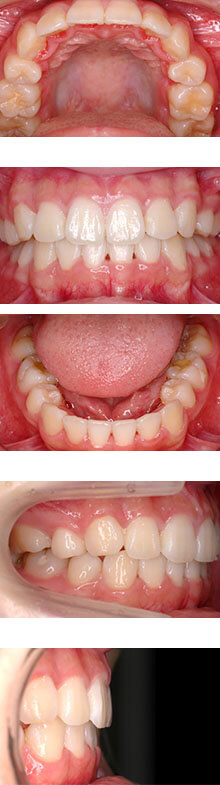 治療後 舌側矯正　N様