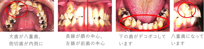 治療前 叢生　A様