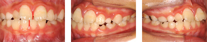 治療前 叢生（そうせい）と顎の右方偏位　O様