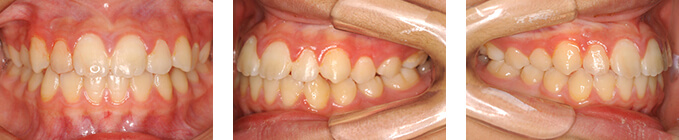 治療後 叢生（そうせい）と顎の右方偏位　O様