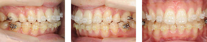 全顎矯正と一般的な部分矯正の違い