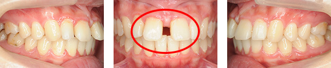 治療前 上顎前歯部すきっ歯