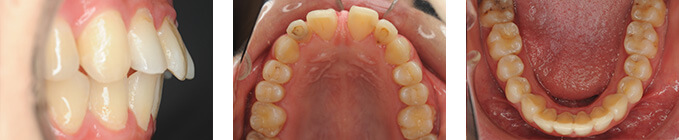 治療前 上顎前歯部すきっ歯
