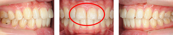 治療後 上顎前歯部すきっ歯