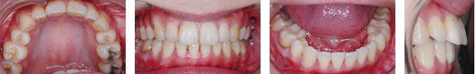 治療後 外科矯正（保険）　Y様　骨格が原因の出っ歯（上顎前突）