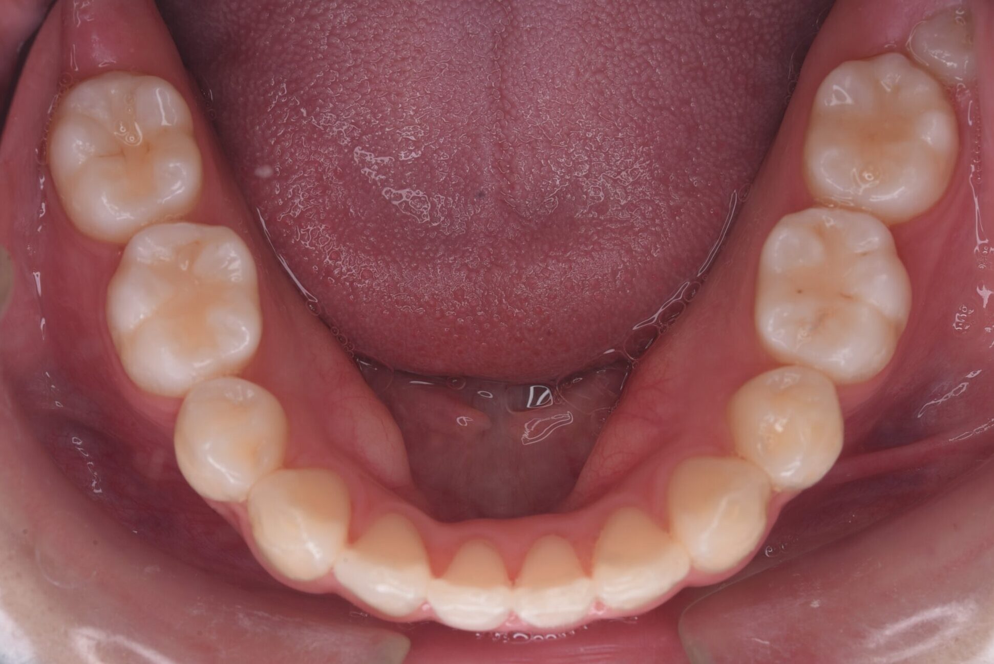 治療後下顎