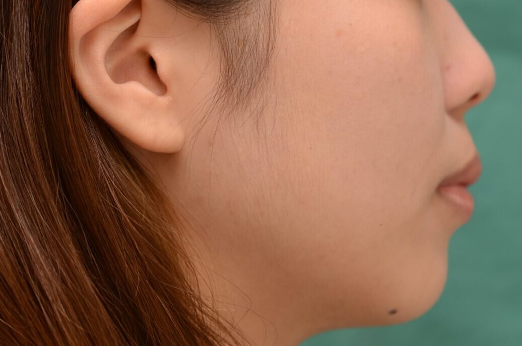初診時横顔
