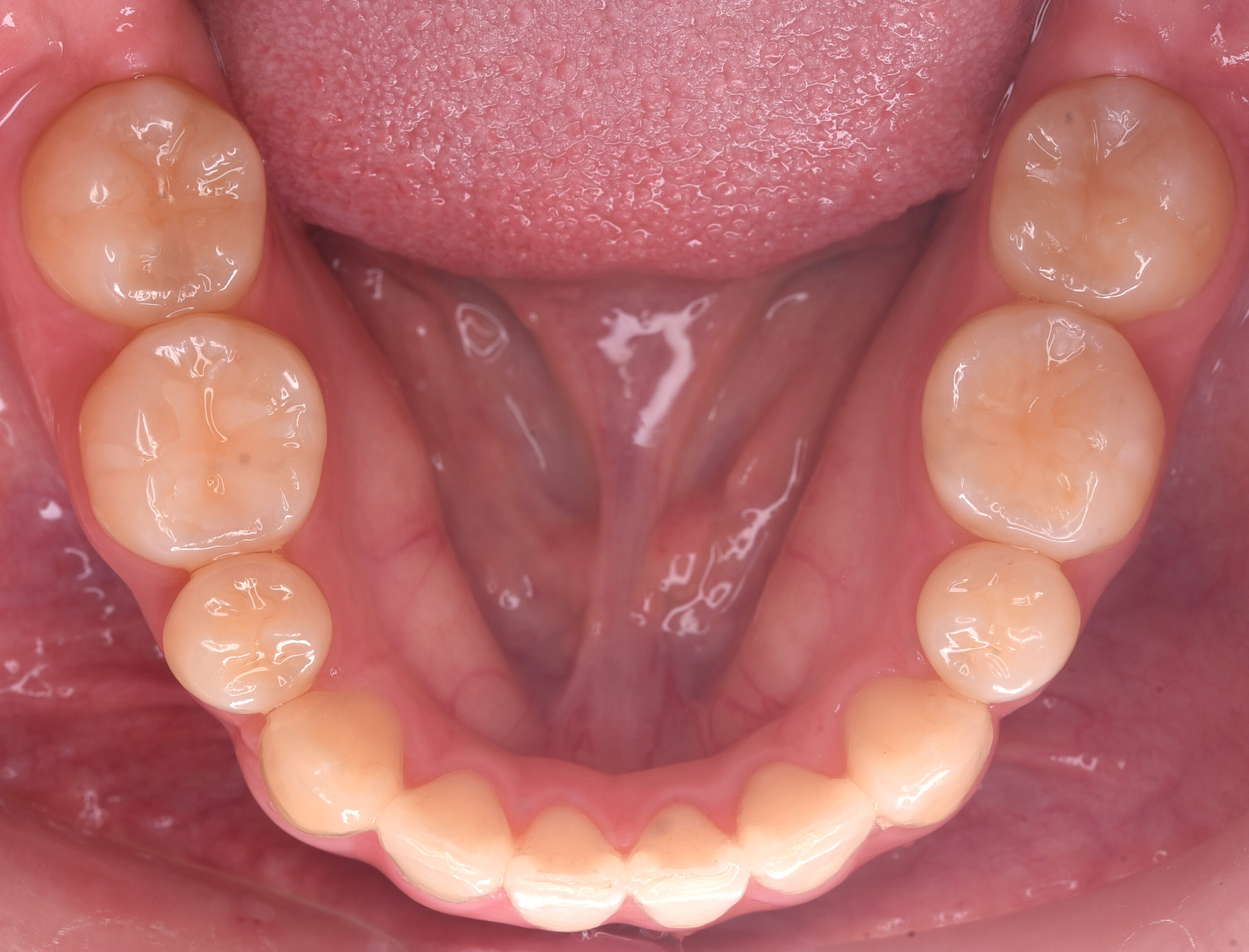 治療後下顎